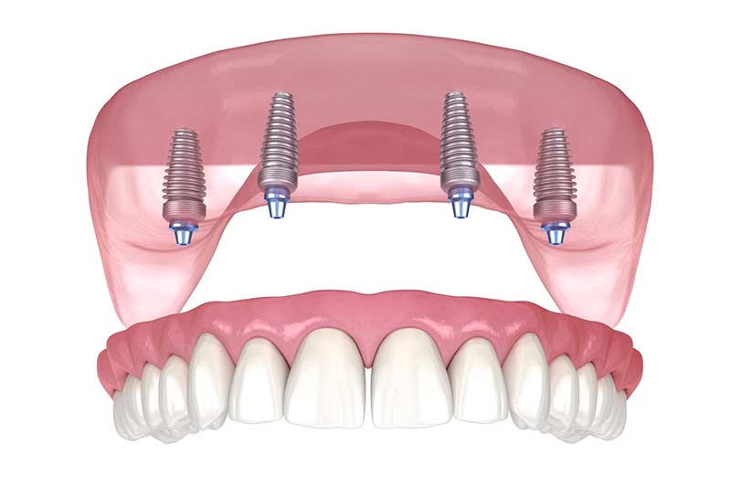 All on 4 Implants | Kyle & Austin TX