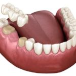 Dental Bridge | Kyle & Austin TX