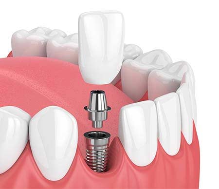 Dental Implants | Kyle & Austin TX
