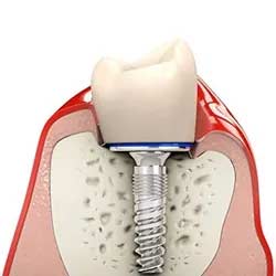 Single Tooth Implant | Kyle & Austin TX