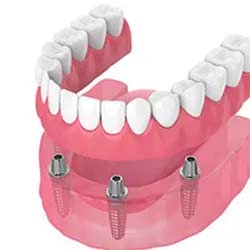 Snap-on Dentures | Kyle & Austin TX